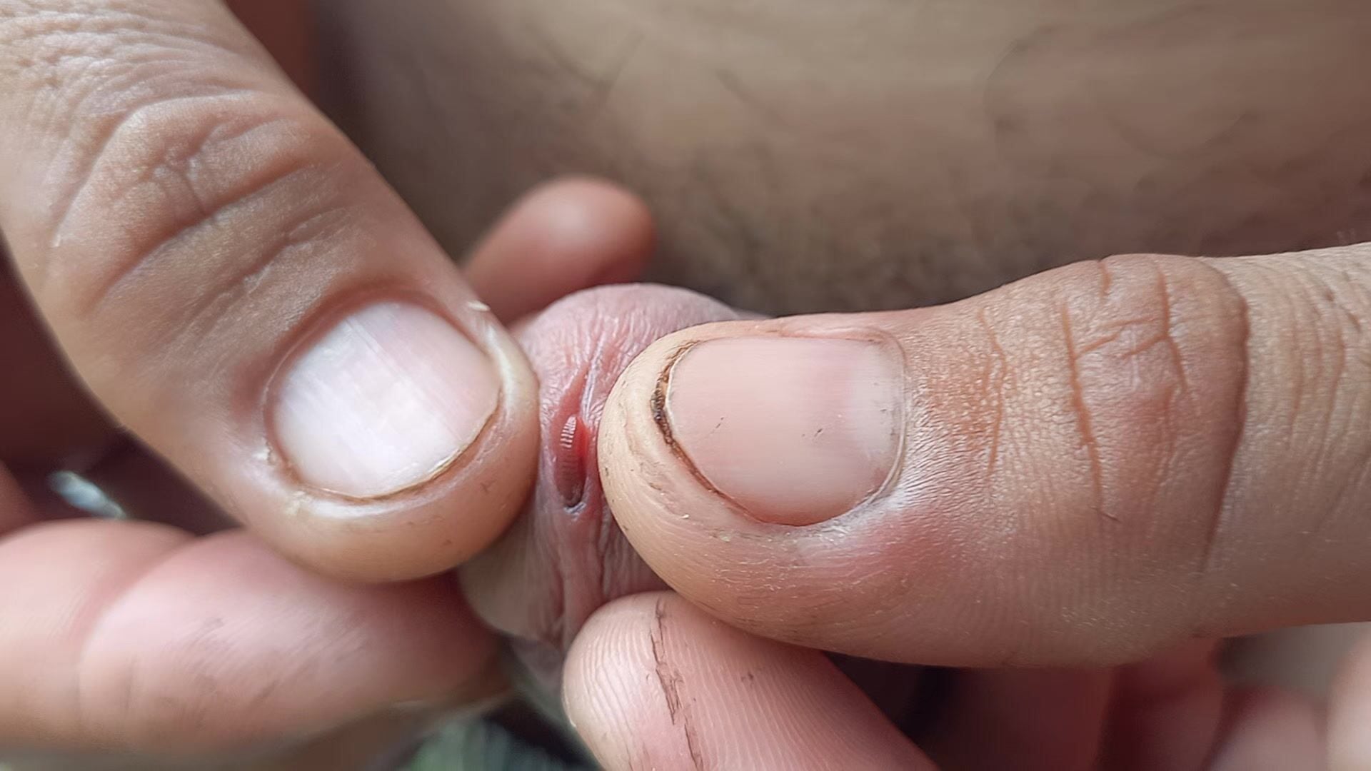 Thả giun vào cu 2